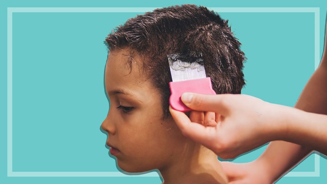removing nits using head lice comb